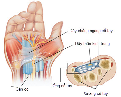 Hội chứng ống cổ tay và cách điều trị - Ảnh 1