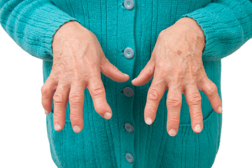 Viêm khớp: Nếu các khớp ngón tay bị sưng to, có thể bạn đang bị viêm khớp - căn bệnh liên quan đến tuổi tác. Bệnh viêm khớp thường kèm theo đau và cứng khớp. 